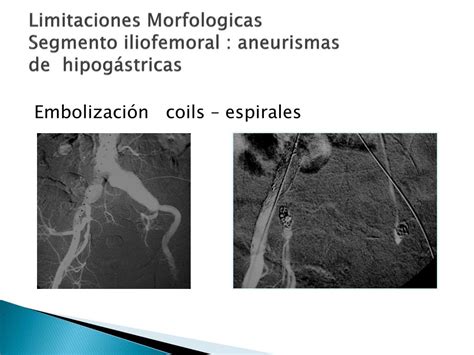 Ppt Tratamiento Endovascular Aaa Powerpoint Presentation Free