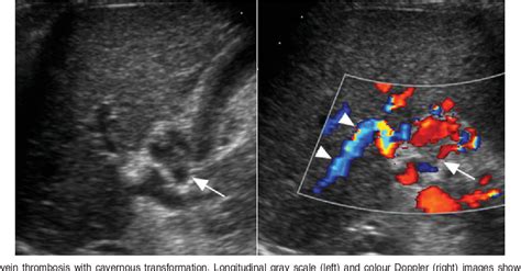 Figure 1 From A Pictorial Review Of Splenic Pathology At Ultrasound