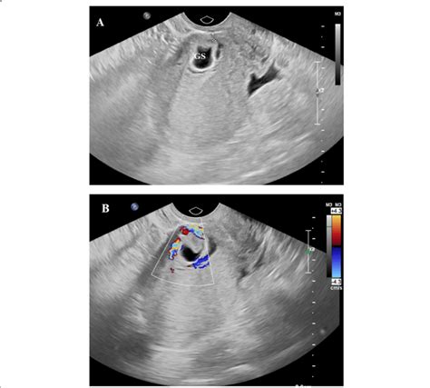 Transabdominal Ultrasound A Of A Patient With Caesarean Scar