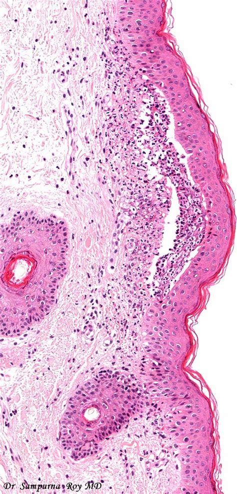 Pin On Dermatopathology Posts Articles Illustrations And Quiz Cases