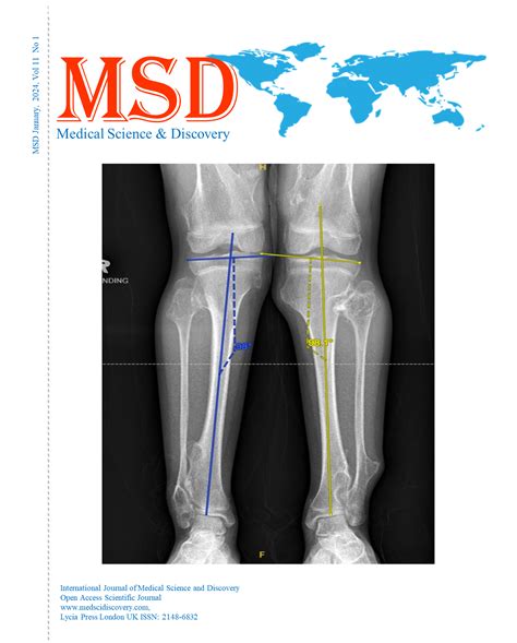 Growth Modulation In Genu Valgum Secondary To Multiple Hereditary