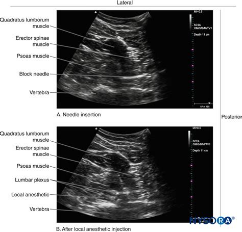 Lumbar Paravertebral Sonography And Considerations For Ultrasound