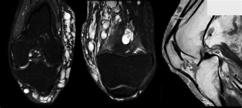 SciELO Brasil Conservative Management Of Knee Arthropathy In A