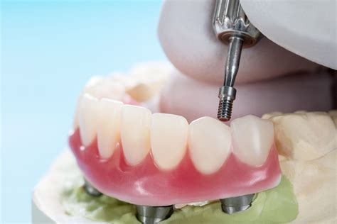 Protesi Overdenture Cos E Quando Viene Scelta Medical Noalese