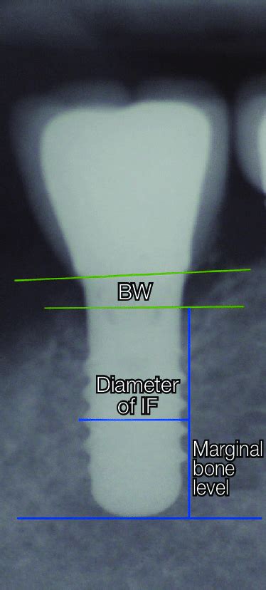 Measurements on periapical radiography. BW: Biologic width, IF: Implant ...