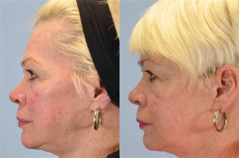 Laser Resurfacing Gallery Dr Paul Vanek Md