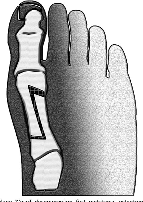 Figure From End Stage Osteoarthritis Of The Great Toe Hallux Rigidus