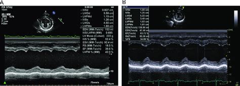 M Mode Echocardiograms A Before Ablation Dyssynchrony Is Observed