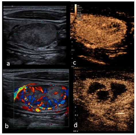 abnormal thyroid cancer ultrasound colors - Antoine Fry