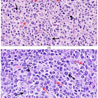 Follicular lymphoma with unusual cytological features (H&E ×400). In ...