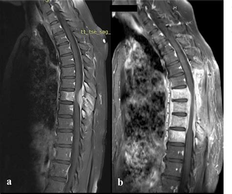 Figure From Lomentospora Prolificans Vertebral Osteomyelitis With