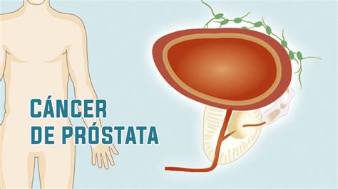 Guía Esencial Del Cáncer De Próstata— Parte 1 Síntomas Y Causas