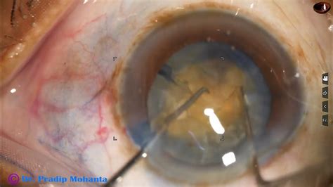 Morgagnian Cataract With Anterior Capsular Fibrosis Hard Nucleus And