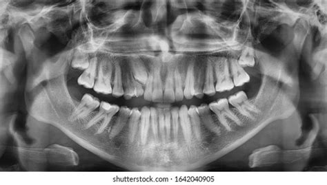 Teeth Root Xray Royalty-Free Images, Stock Photos & Pictures | Shutterstock