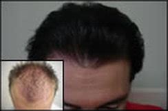 Eyebrow Hair Loss Causes and Cures - Hair Loss Specialist