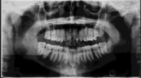 Interpretation Of Panoramic Radiograph Flashcards Quizlet