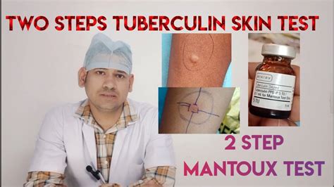 Two Step Tuberculin Skin Testtwo Steps Mantoux Test Mantoux Test Ppd