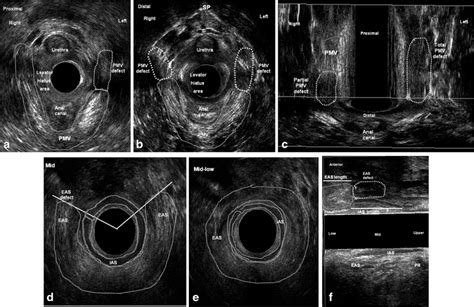 Representative Three Dimensional Ultrasonography Images Of Bilateral