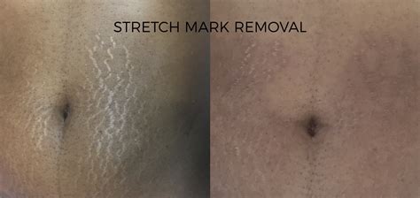 stretch-marks-removal-before-and-after | Skintellect