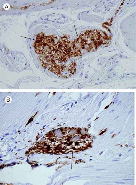 S-100 expression in the myenteric plexus of a control (A) and a patient ...