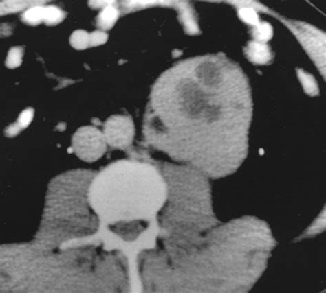 Ct Features Of Castleman Disease Of The Abdomen And Pelvis Ajr