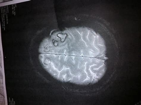 Tumor: X Ray Picture Of Brain Tumor