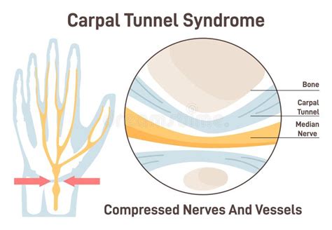 Sindrome Del Tunnel Carpale Nervo Mediano Compresso Anatomia Del