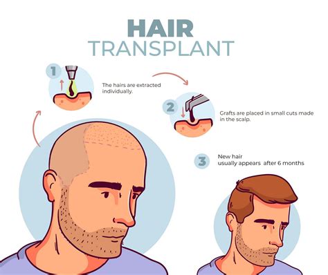 The Ultimate Guide To Hair Transplant What You Need To Know