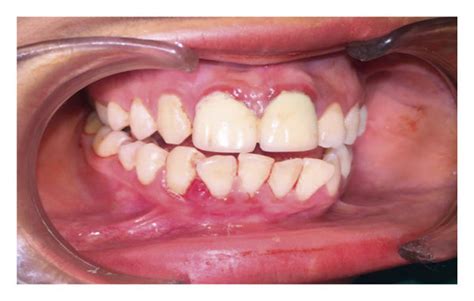 Case Of Pyogenic Granuloma Of Gingival Region Treated With