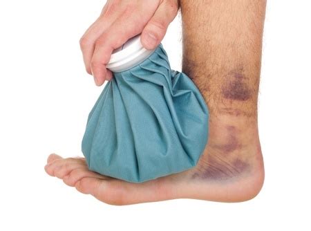 Treat Sprained Ankle Syracuse Podiatry Dr Ryan Damico