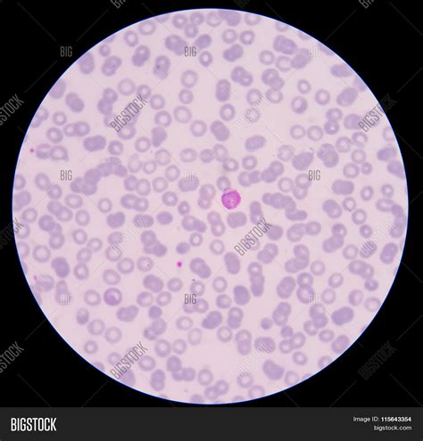 Blood Smear Malaria Image & Photo (Free Trial) | Bigstock