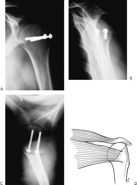 Deltoid Tuberosity X Ray