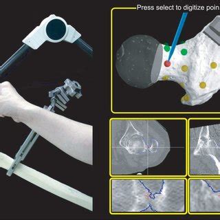 Anterior Pelvic Plane APP And Functional Pelvic Plane FPP