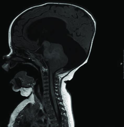 Magnetic Resonance Imaging Brain Sagittal View With Large Cyst Over The Download Scientific