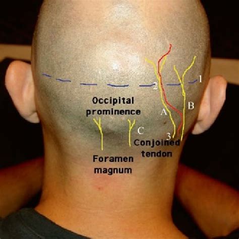 3 Differential diagnosis of occipital pain | Download Table