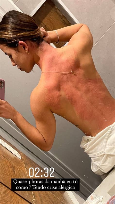 Ex BBB22 Larissa tem crise alérgica e corpo inchado choca veja fotos