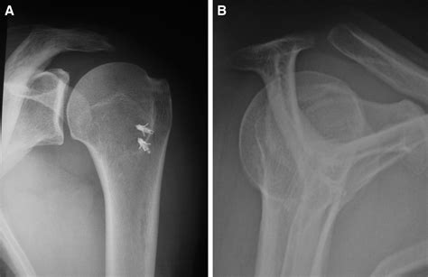 Acromion Reconstruction After Failed Subacromial Decompression In