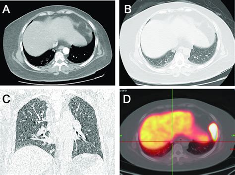 A Two Rounded Nodules In The Right Lower Lobe Of The Lung With Download Scientific Diagram