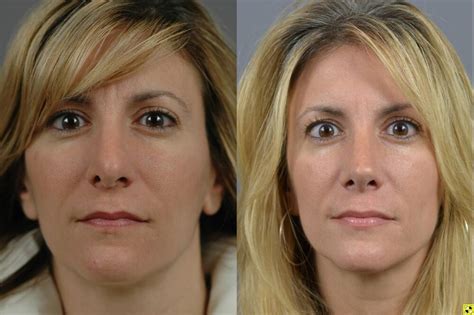 Revision Rhinoplasty Before After Long Island Dr Marotta