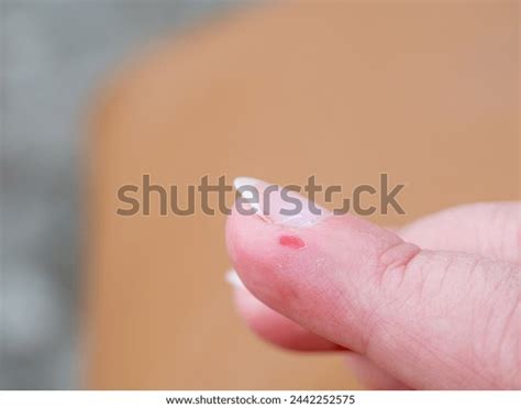 37 Abrasion Index Finger Images, Stock Photos, 3D objects, & Vectors ...