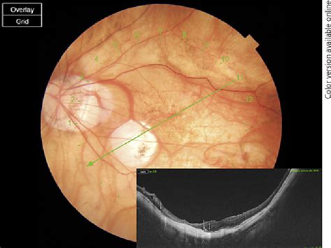 Figure 1 From Evolution Of Macular Bruch Membrane Defects Of Patchy Chorioretinal Atrophy In