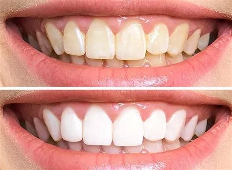 Teeth Whitening Get The Best Teeth Whitening From Anderson Dental