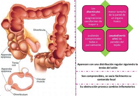 Enfermedad Diverticular De Colon