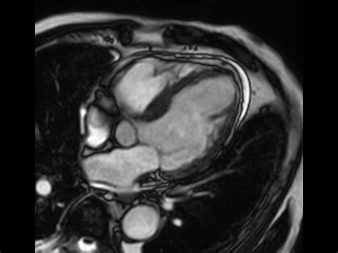 Cardiac Infarction With Fat Free Mdixon Imaging Philips Mr Body Map