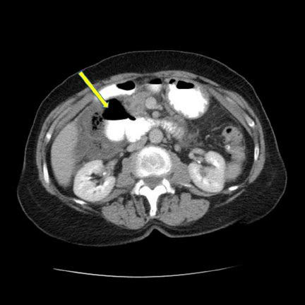 Computed Tomography Ct Scan Of The Abdomen With Oral Contrast The