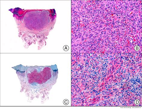 Immunohistochemistry In Dermatopathology A Review Of The Most Commonly