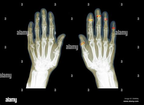 Interphalangeal joints osteoarthritis hi-res stock photography and ...