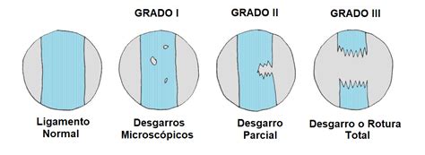 Esguinces de rodilla Qué es causas síntomas tratamiento y consejos