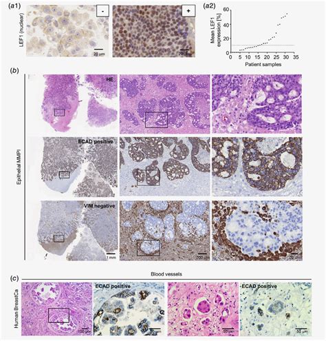 LEF1 E Cadherin And Vimentin Expression In Human Brain Metastases