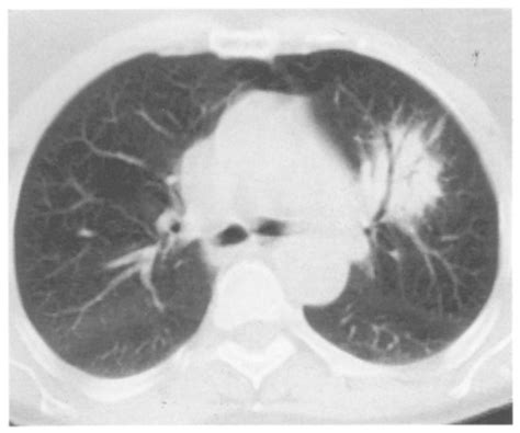 Case Axial Ct Section Lung Windows Demonstrating Typical Dense